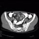 Crohn's disease of ileum, CT routine, 2005: CT - Computed tomography